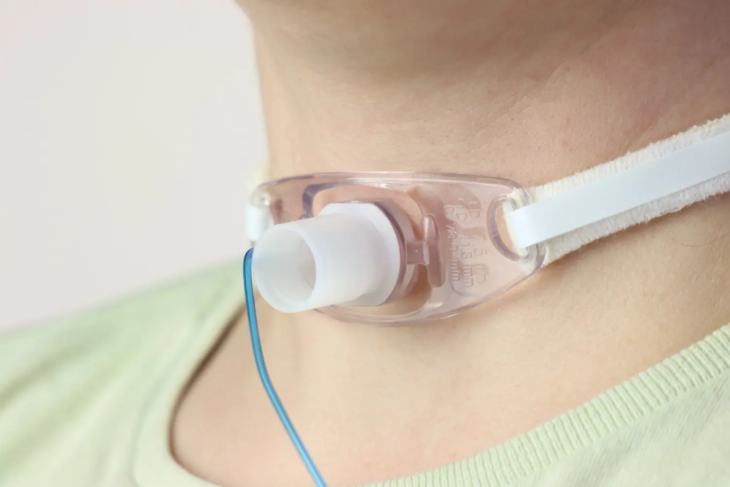 Tracheostomiekanülenmanagement in der ambulanten Intensivmedizin von Marvin Kuberski